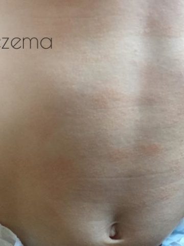 natural eczema treatment and remedies