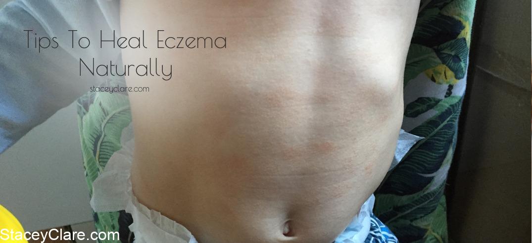 natural eczema treatment and remedies